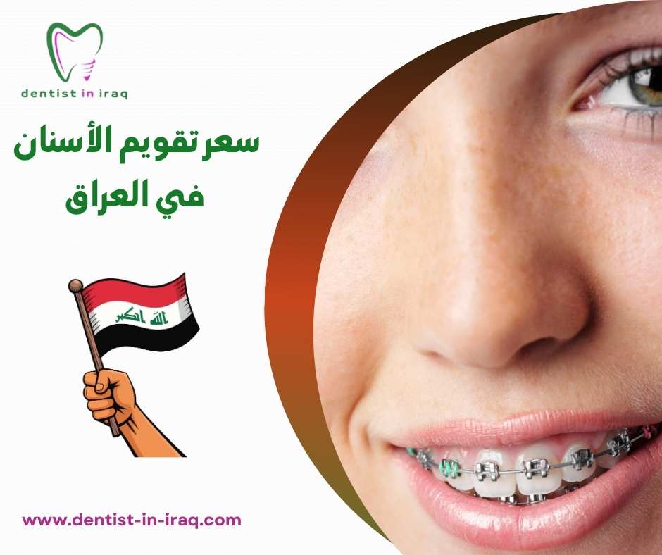 سعر تقويم الأسنان في العراق