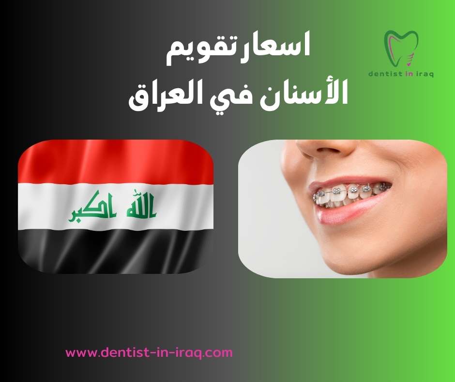 اسعار تقويم الأسنان في العراق