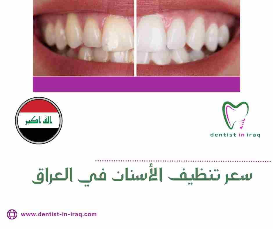 سعر تنظيف الأسنان في العراق