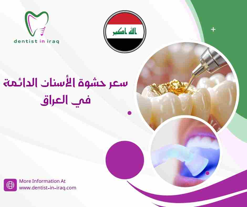 سعر حشوة الأسنان الدائمة في العراق