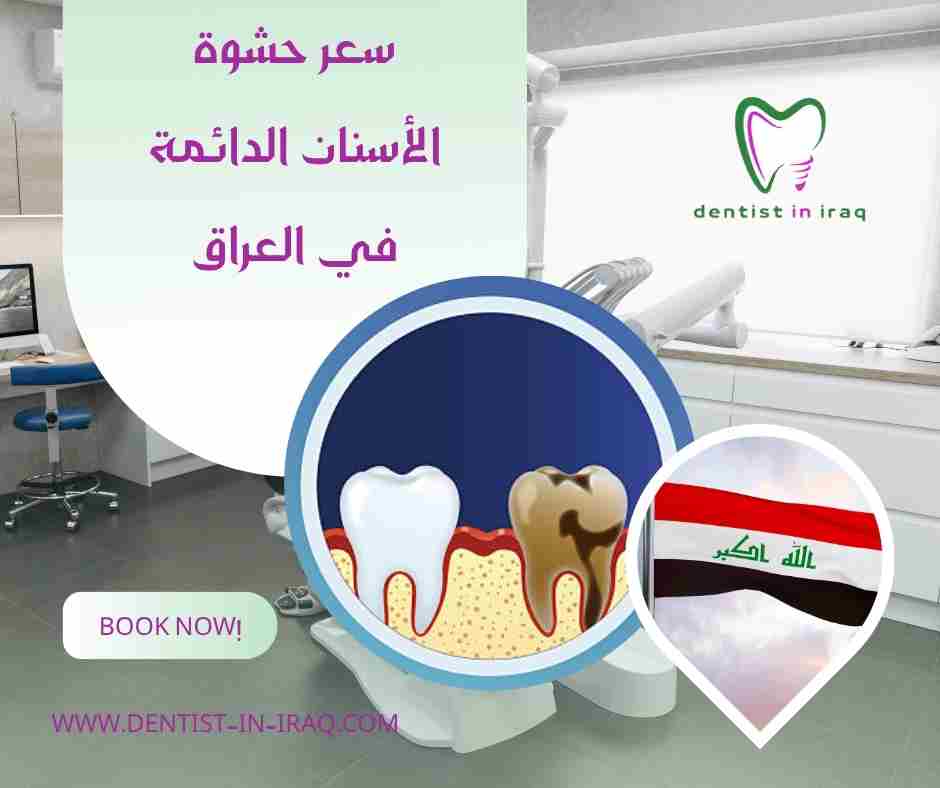 سعر حشوة الأسنان الدائمة في العراق