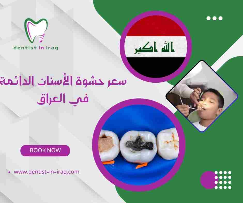 سعر حشوة الأسنان الدائمة في العراق