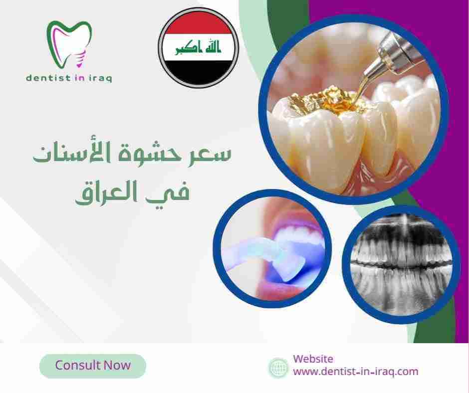 سعر حشوة الأسنان في العراق