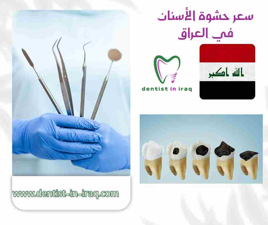 سعر حشوة الأسنان في العراق