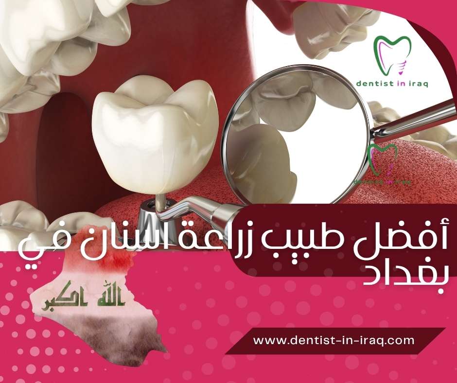 أفضل طبيب زراعة أسنان في بغداد