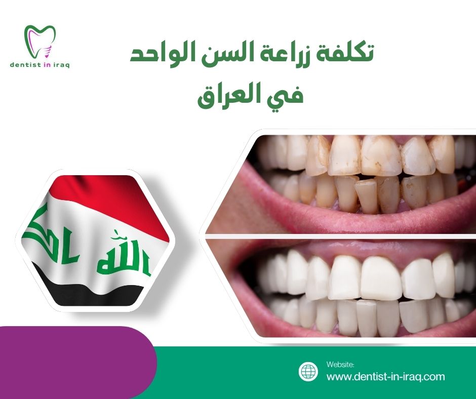 تكلفة زراعة السن الواحد في العراق