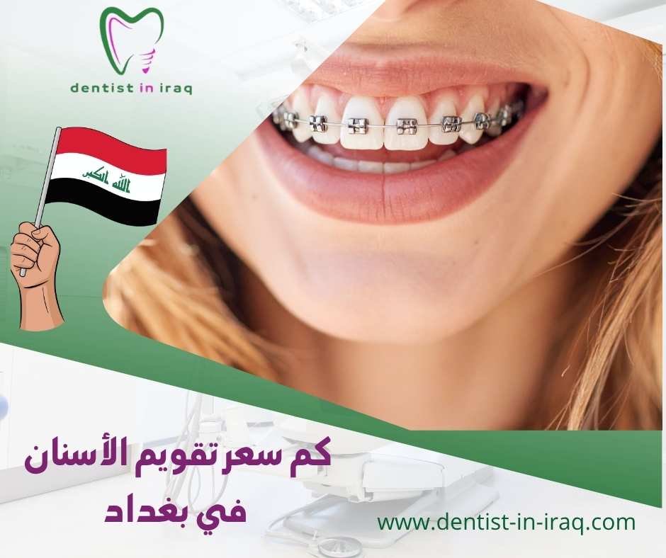 كم سعر تقويم الأسنان في بغداد