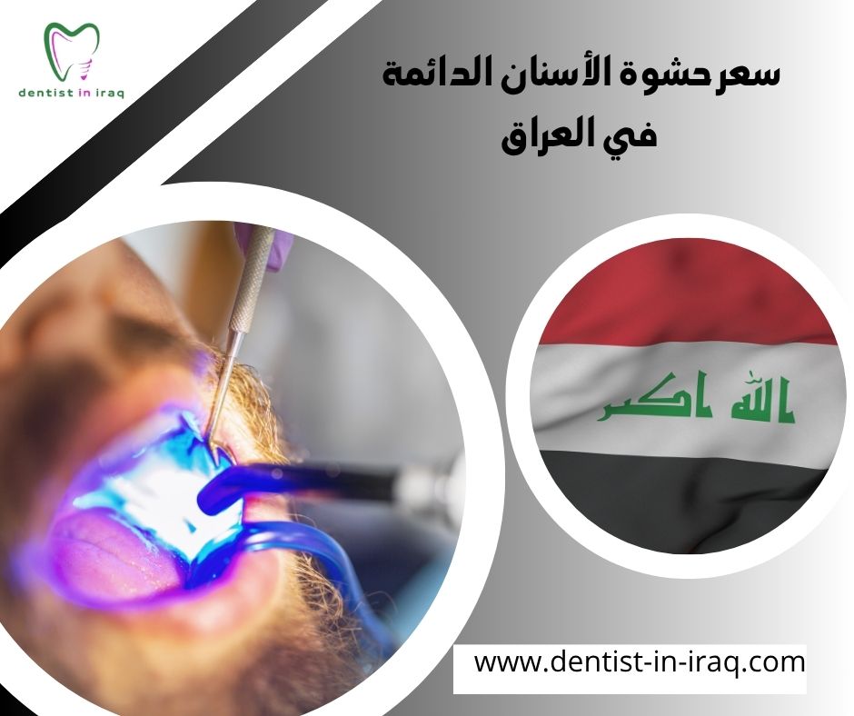 سعر حشوة الأسنان الدائمة في العراق