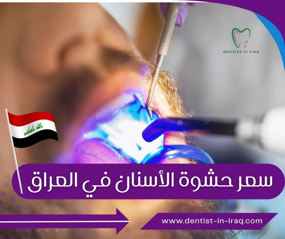 سعر حشوة الأسنان في العراق