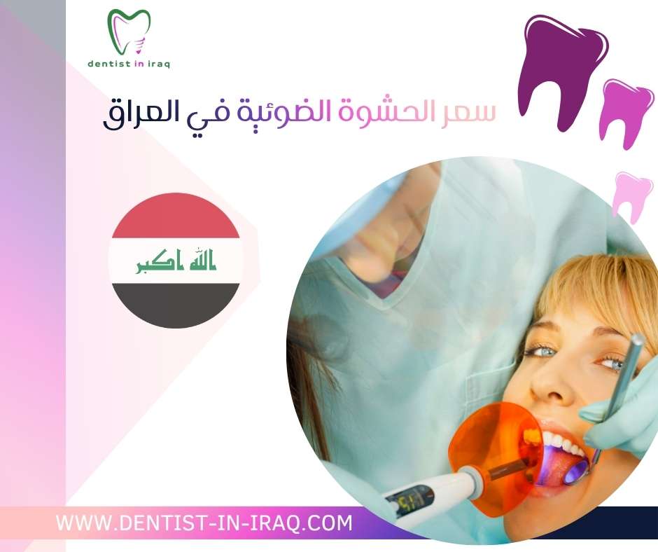 سعر الحشوة الضوئية في العراق