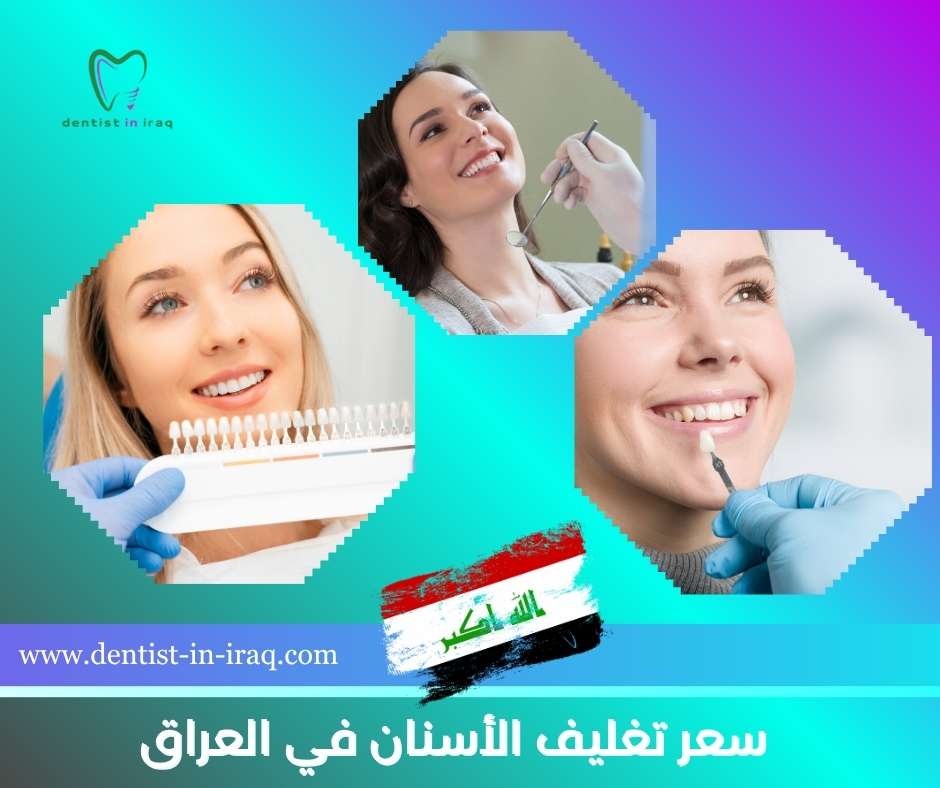 سعر تغليف الأسنان في العراق