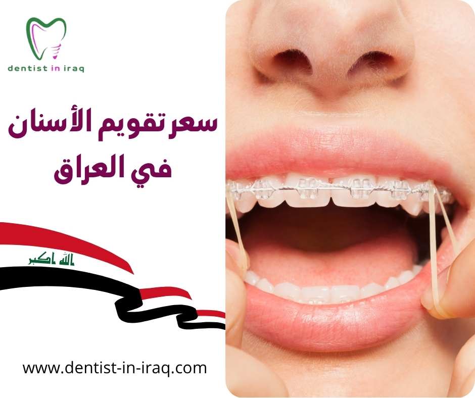 سعر تقويم الأسنان في العراق