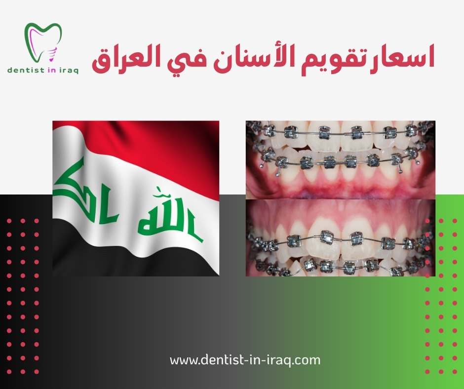 اسعار تقويم الأسنان في العراق