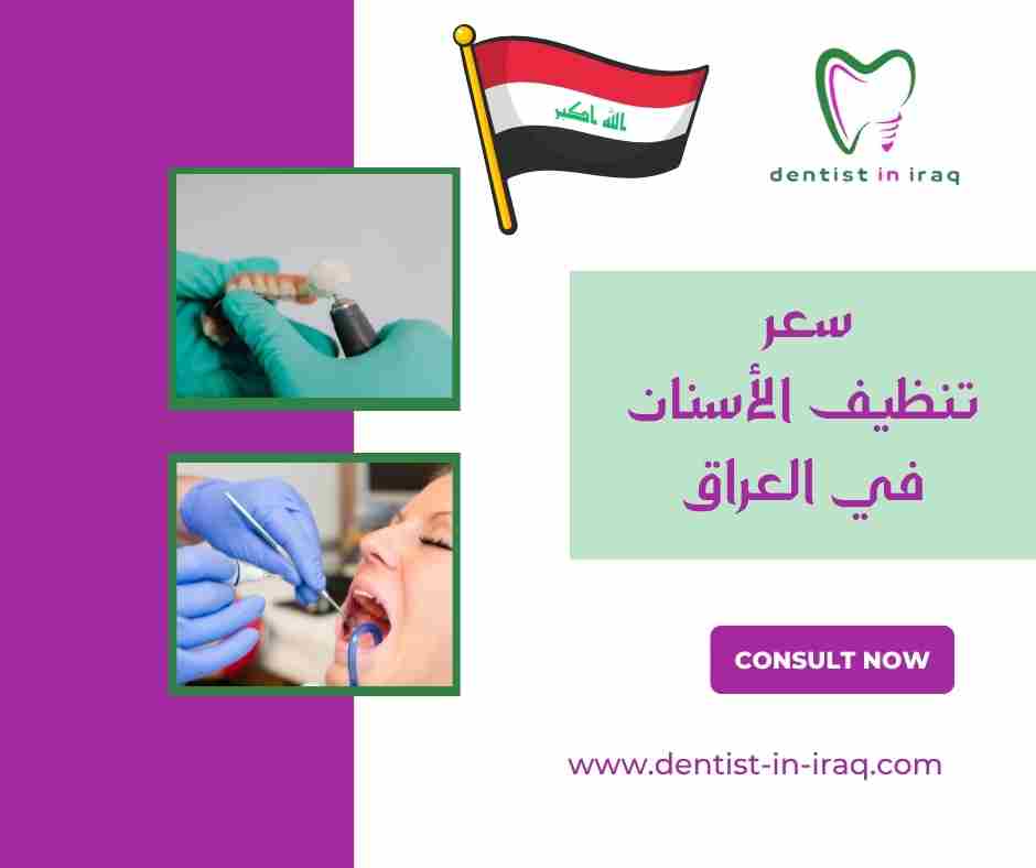سعر تنظيف الأسنان في العراق