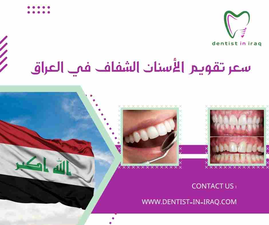 سعر تقويم الأسنان الشفاف في العراق