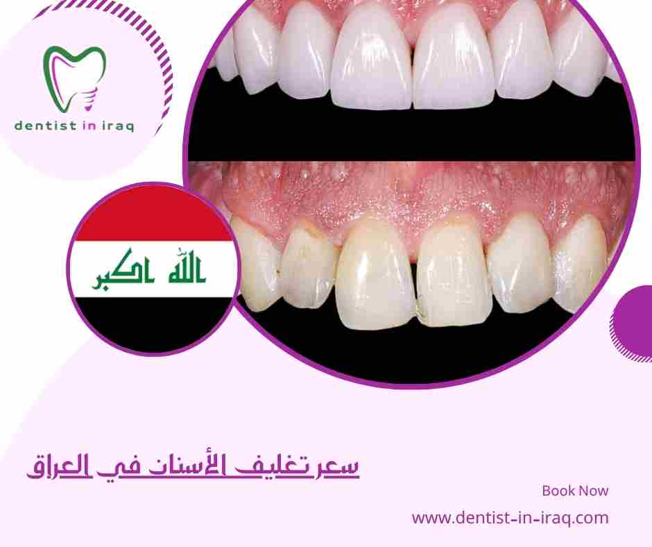 سعر تغليف الأسنان في العراق