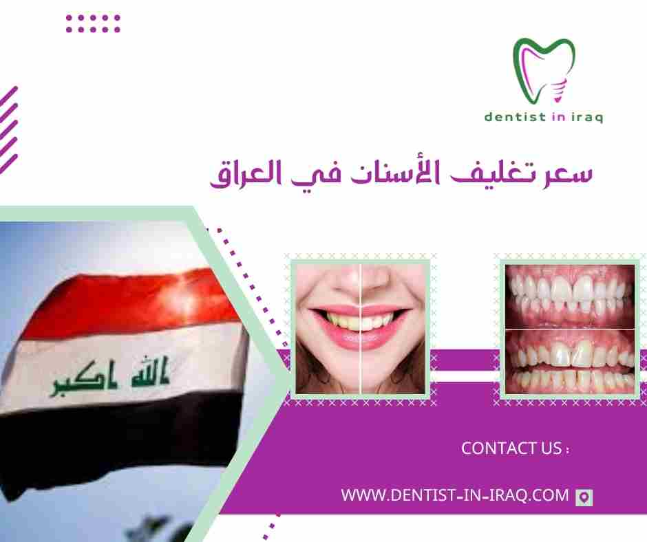سعر تغليف الأسنان في العراق
