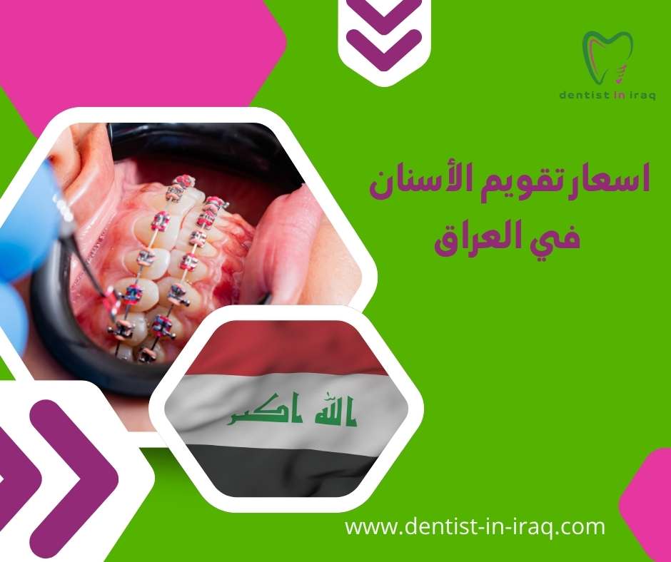 اسعار تقويم الأسنان في العراق