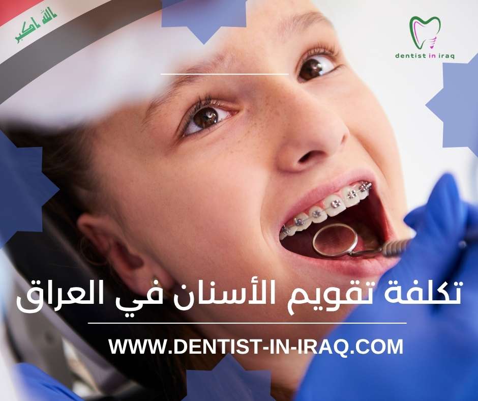 تكلفة تقويم الأسنان في العراق