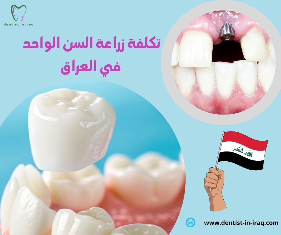 تكلفة زراعة السن الواحد في العراق