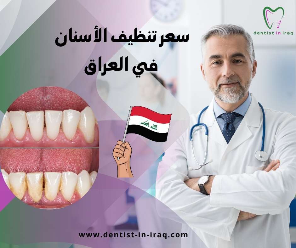 سعر تنظيف الأسنان في العراق