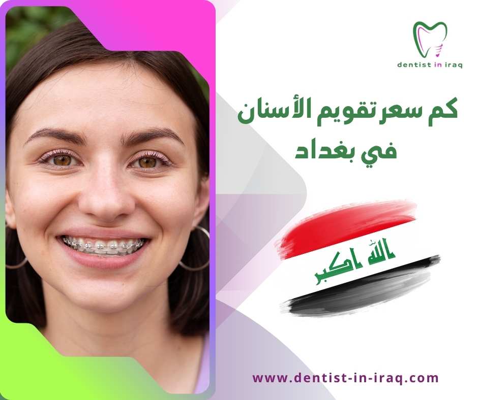 كم سعر تقويم الأسنان في بغداد