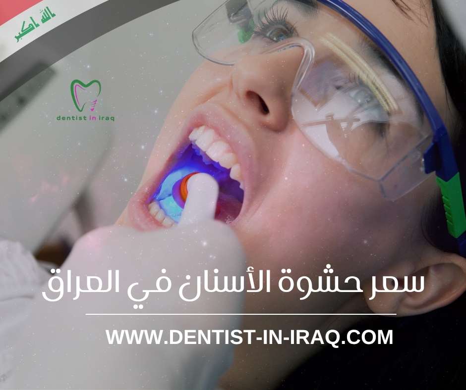 سعر حشوة الأسنان في العراق
