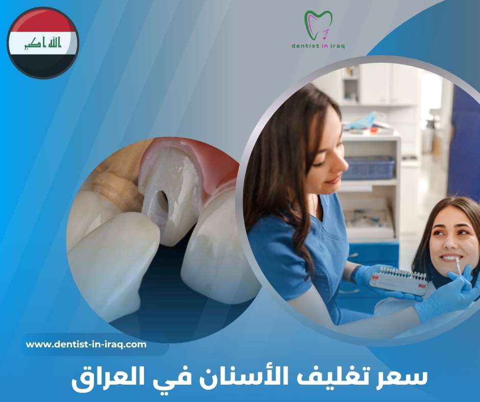 سعر تغليف الأسنان في العراق