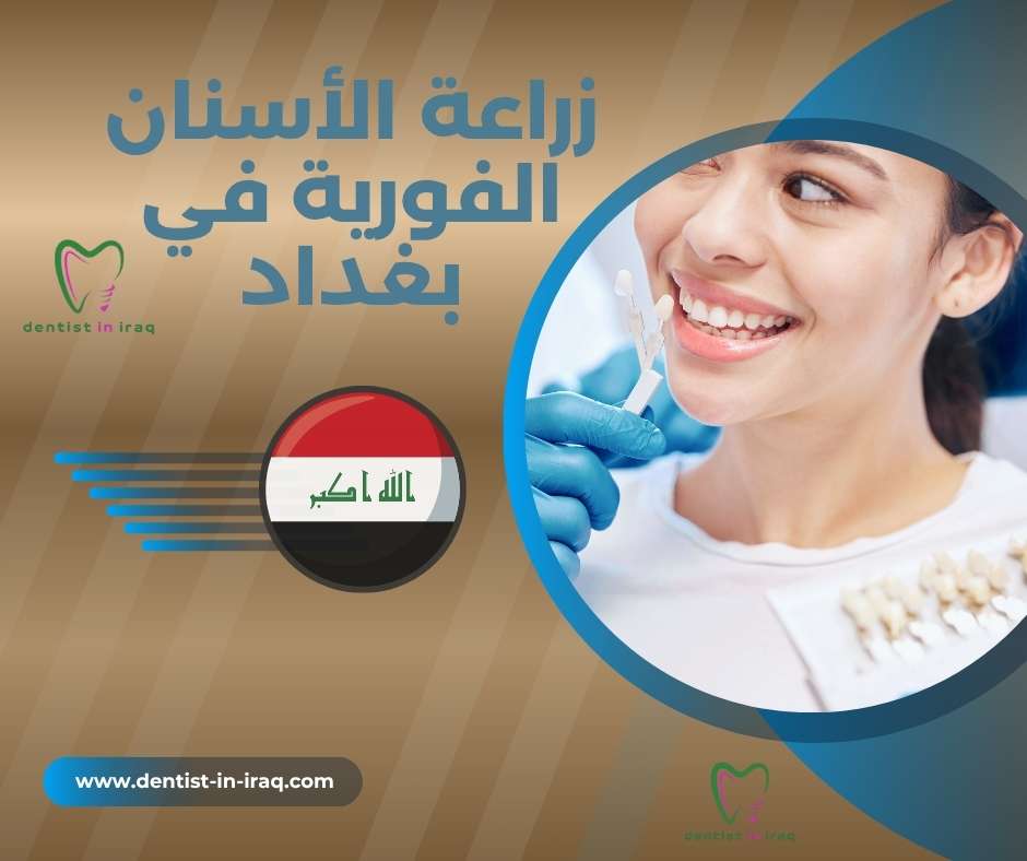 زراعة الأسنان الفورية في بغداد