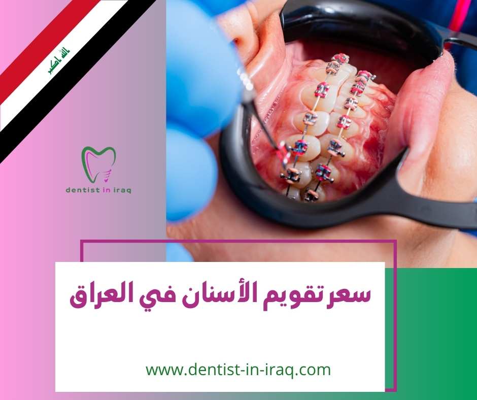 سعر تقويم الأسنان في العراق