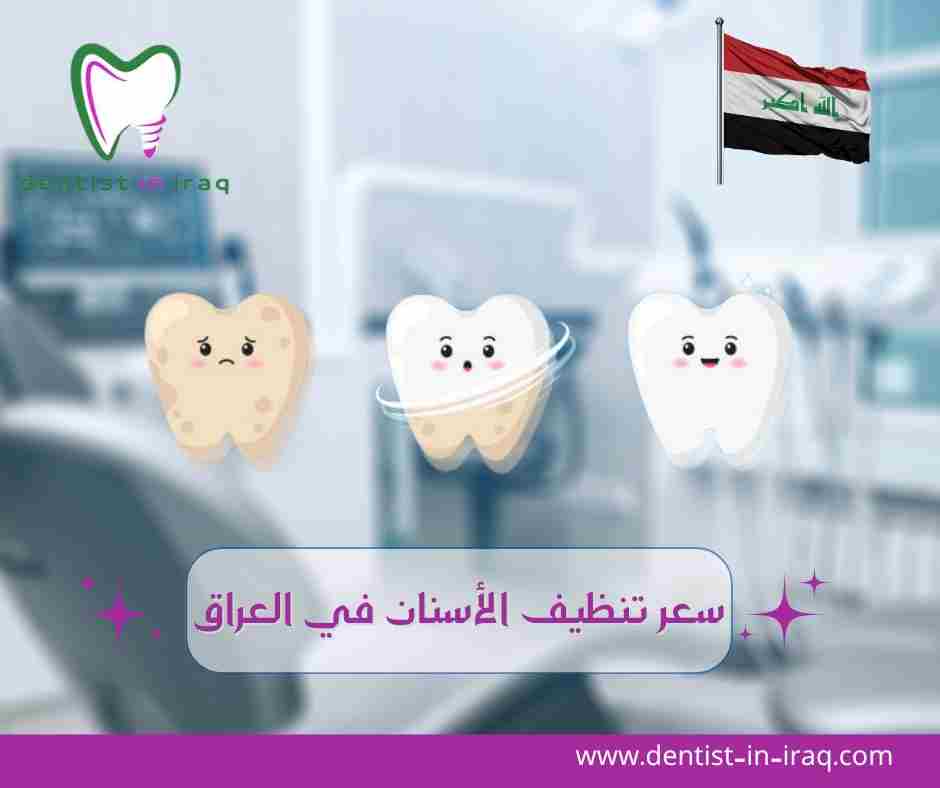 سعر تنظيف الأسنان في العراق