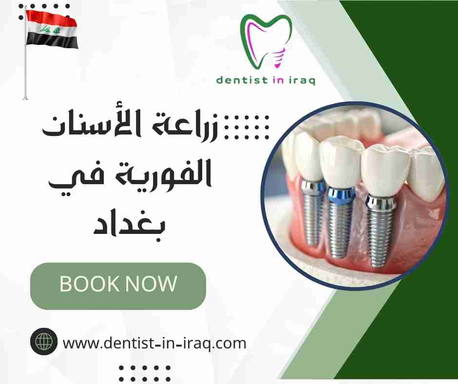 زراعة الأسنان الفورية في بغداد