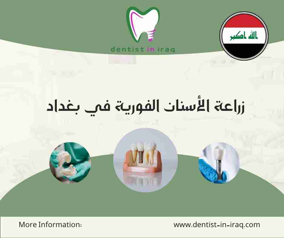 زراعة الأسنان الفورية في بغداد