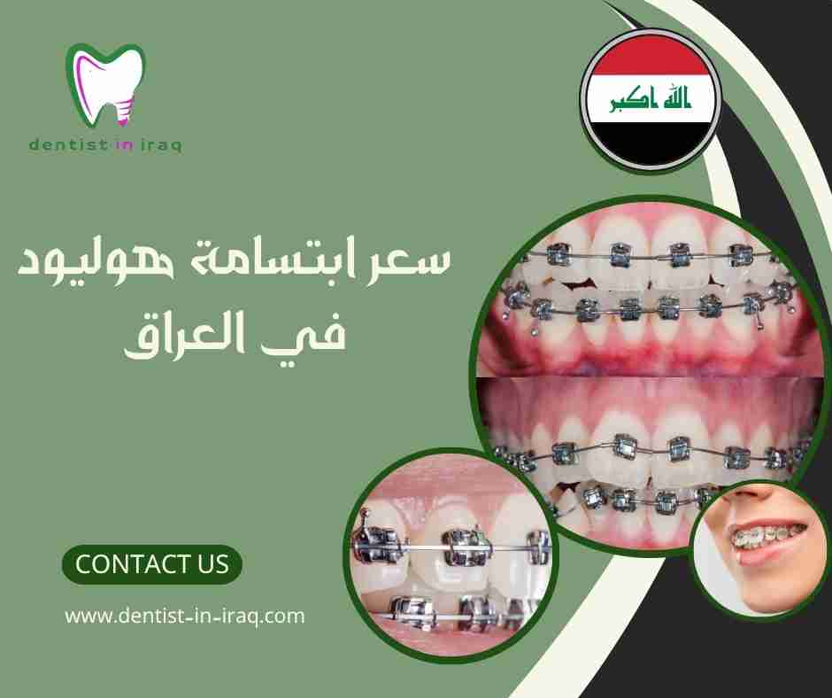 سعر ابتسامة هوليود في العراق