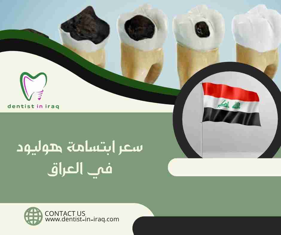 سعر ابتسامة هوليود في العراق