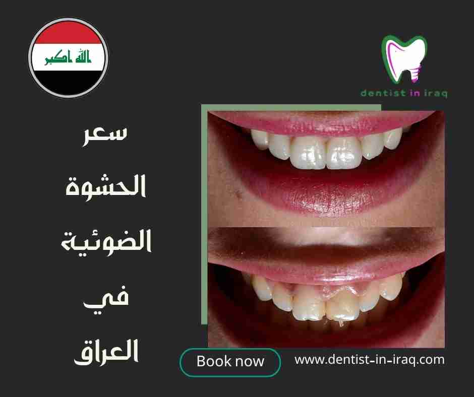 سعر الحشوة الضوئية في العراق