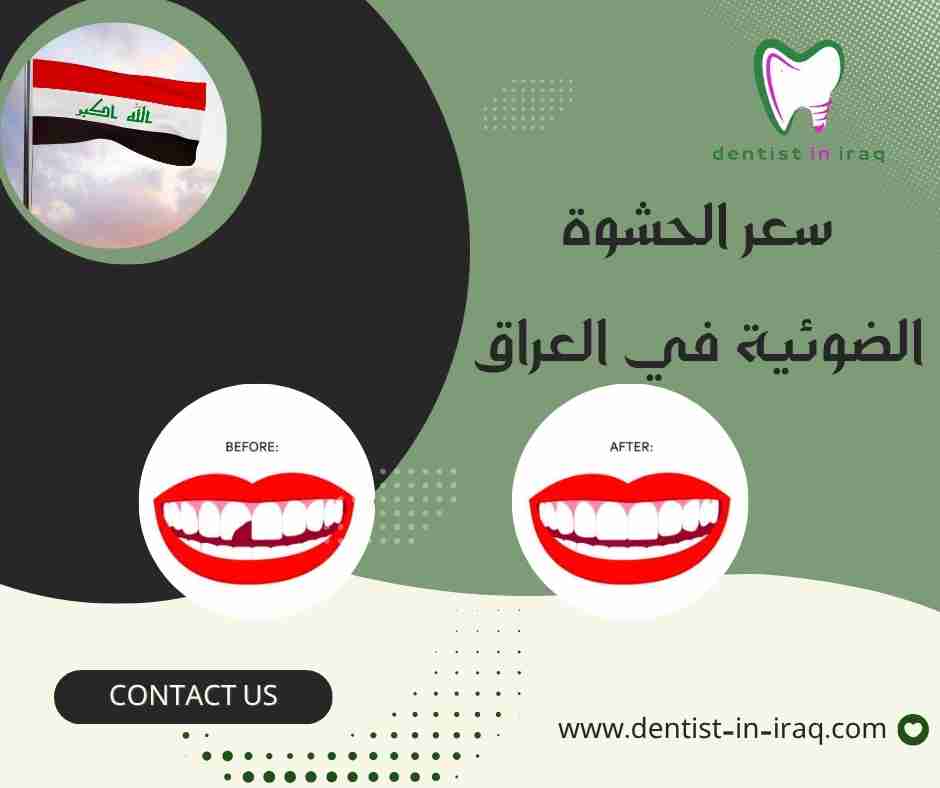 سعر الحشوة الضوئية في العراق
