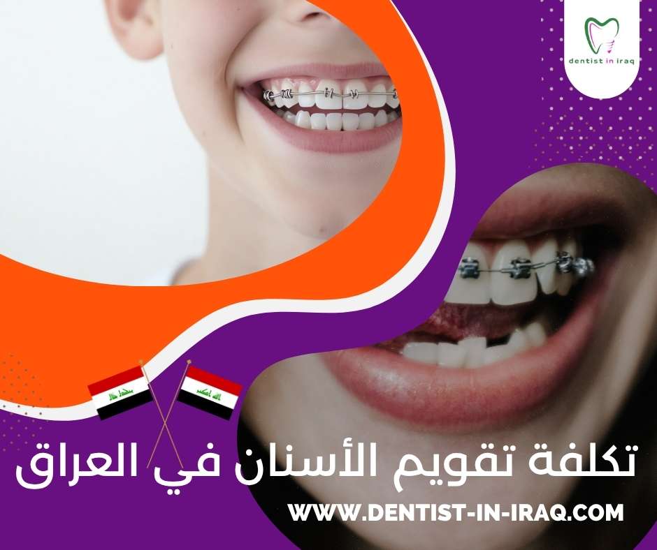 تكلفة تقويم الأسنان في العراق