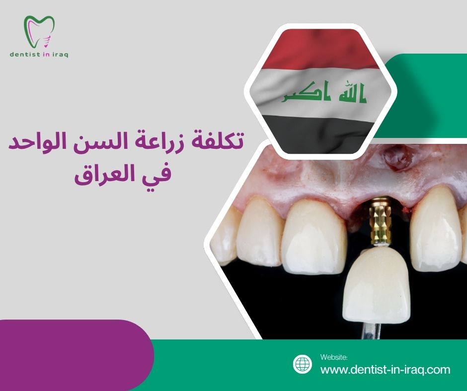 تكلفة زراعة السن الواحد في العراق