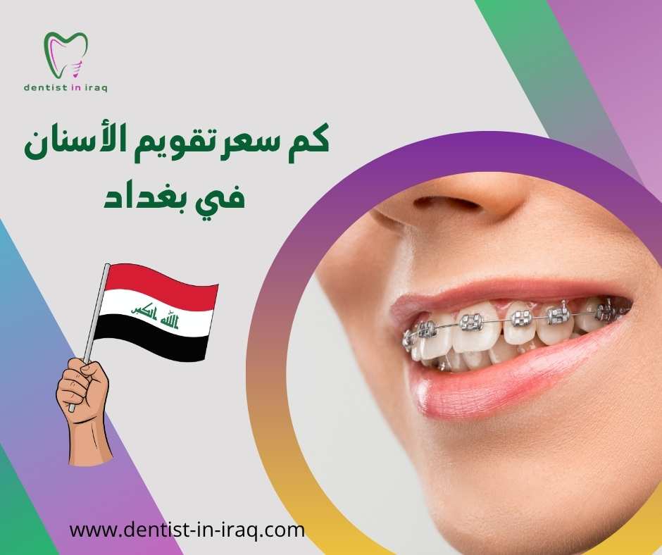 كم سعر تقويم الأسنان في بغداد