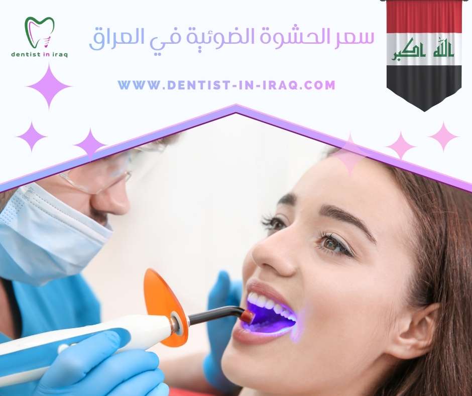 سعر الحشوة الضوئية في العراق