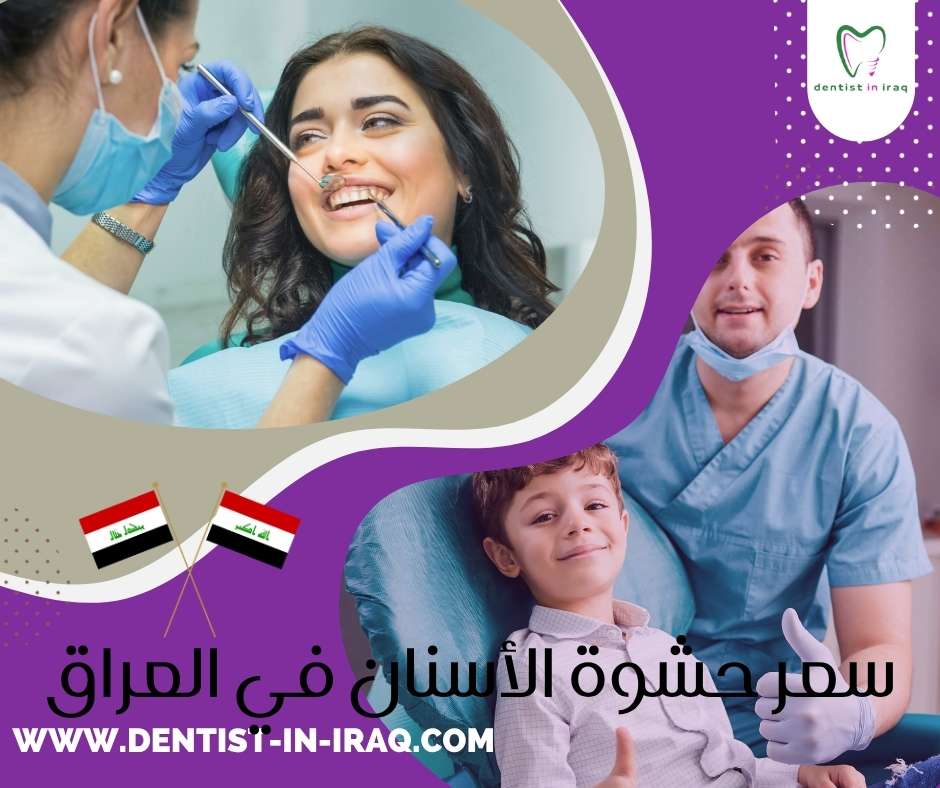 سعر حشوة الأسنان في العراق
