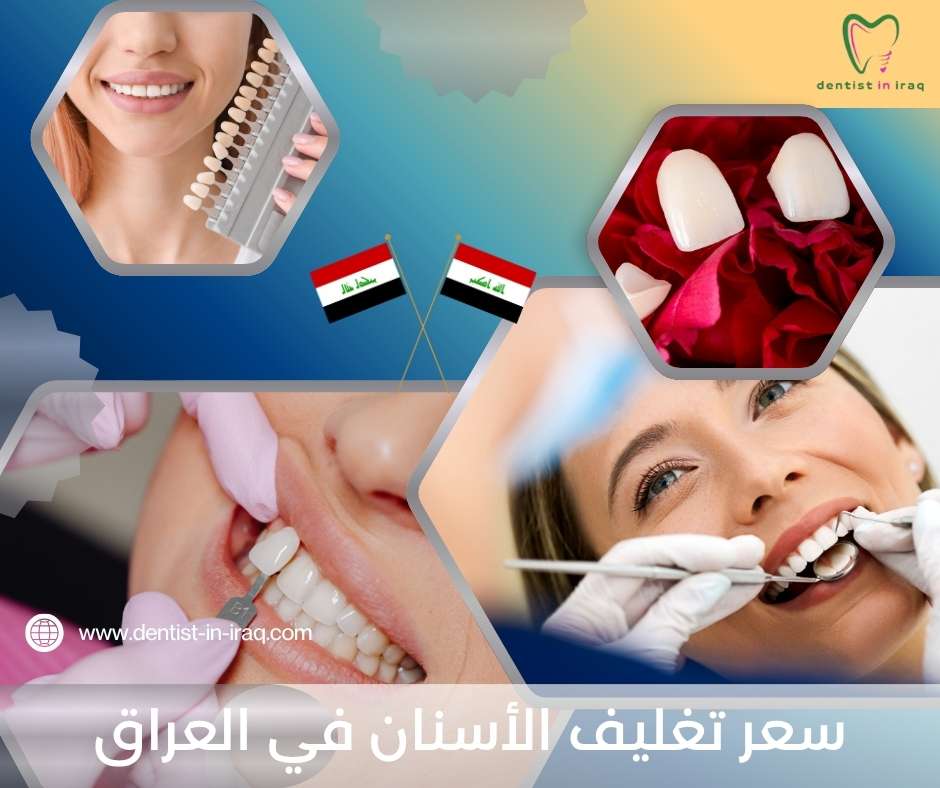 سعر تغليف الأسنان في العراق