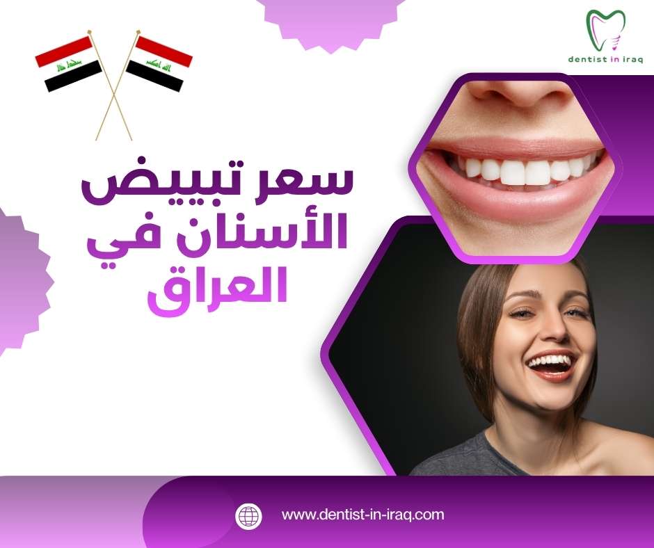 سعر تبييض الأسنان في العراق