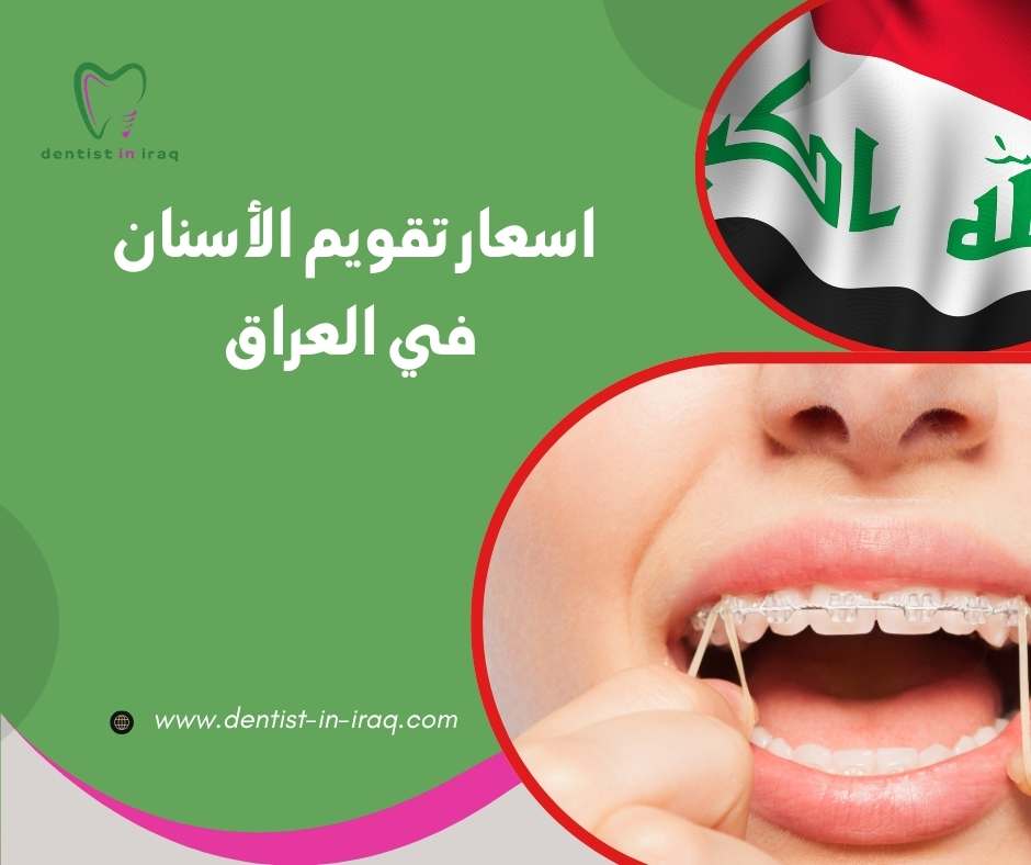 اسعار تقويم الأسنان في العراق