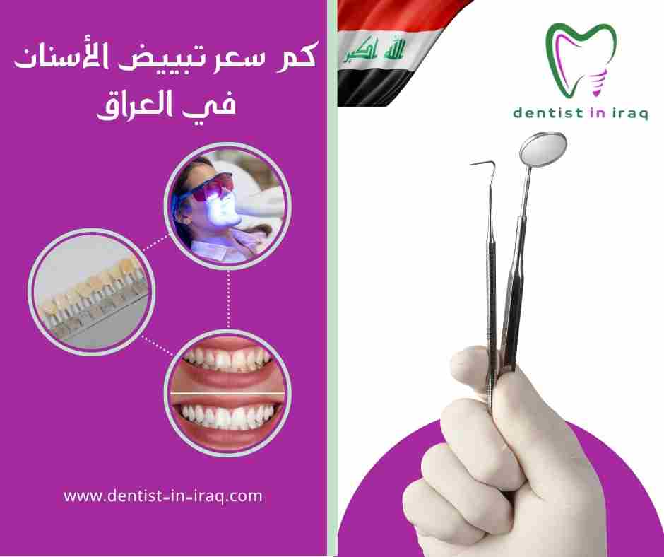 كم سعر تبييض الأسنان في العراق
