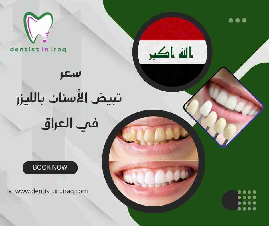 سعر تبيض الأسنان بالليزر في العراق