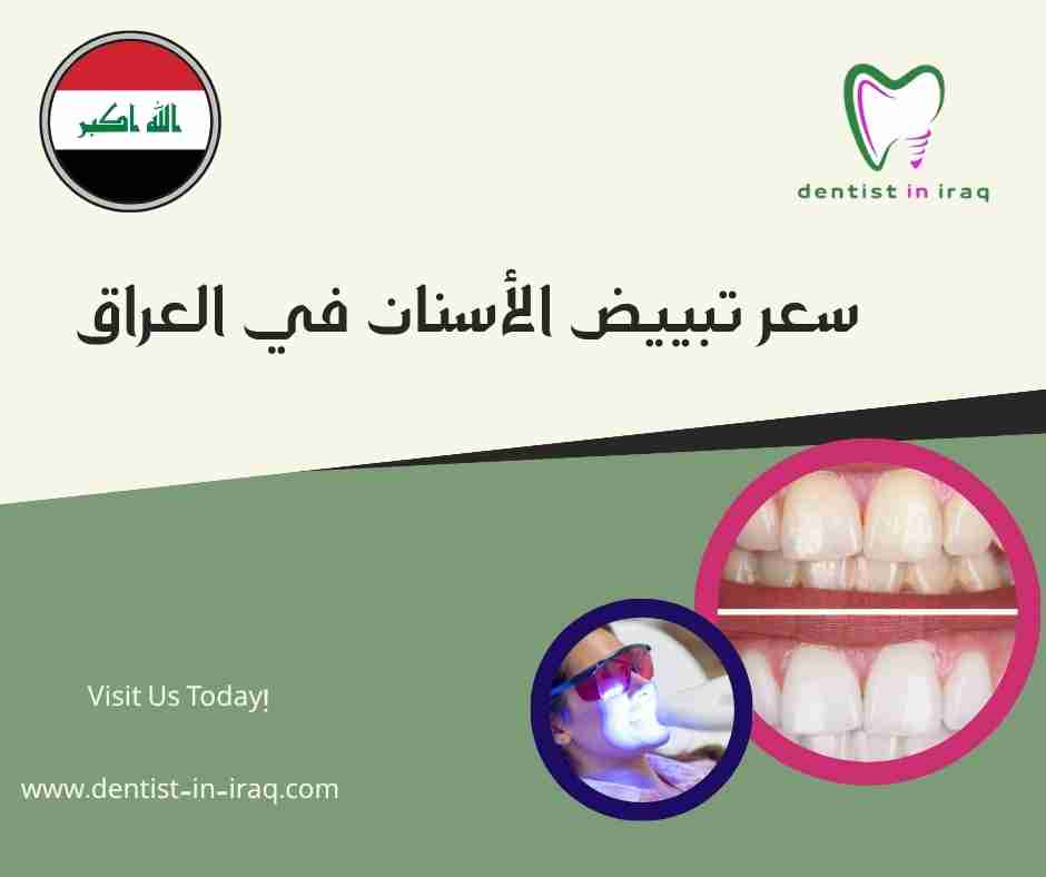 سعر تبييض الأسنان في العراق