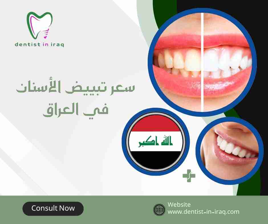 سعر تبييض الأسنان في العراق