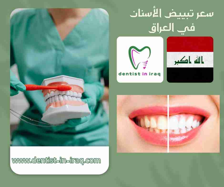 سعر تبييض الأسنان في العراق